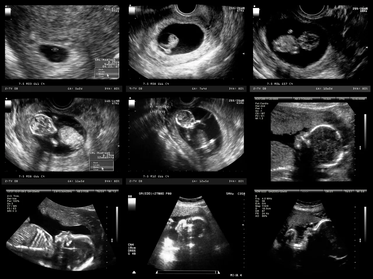 Zdjęcie Badania prenatalne w 12 tygodniu ciąży: kompletny przegląd i przebieg badań