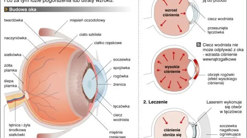 Zdjęcie Czy jaskra jest wyleczalna? Odkryj prawdę o leczeniu tej choroby