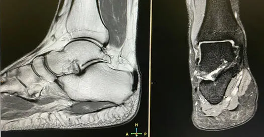 RTG tomografia rezonans stopy