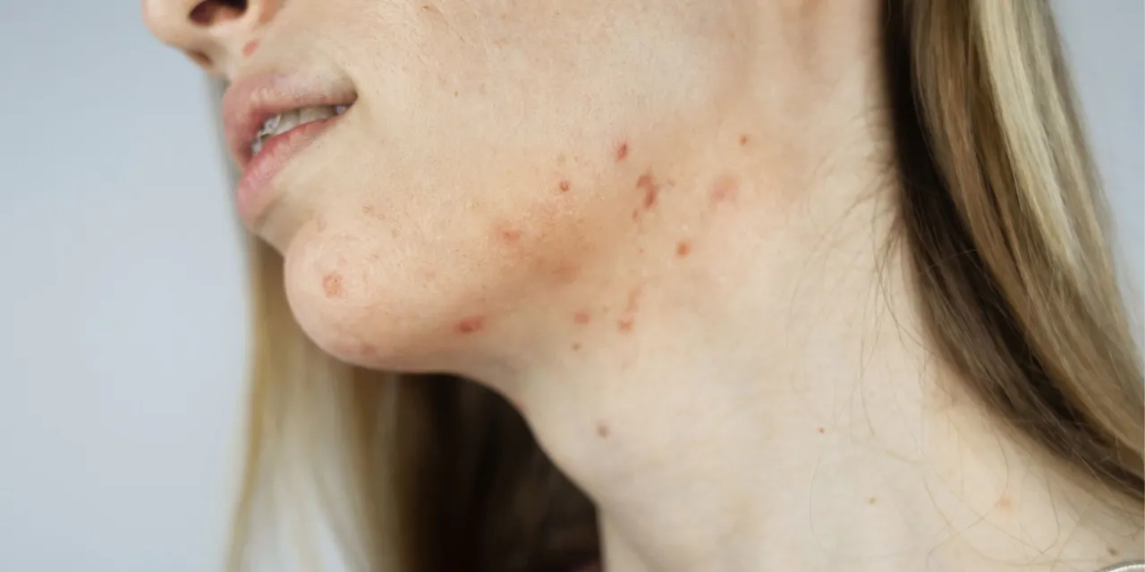 Kobieta z trądzikiem hormonalnym na brodzie