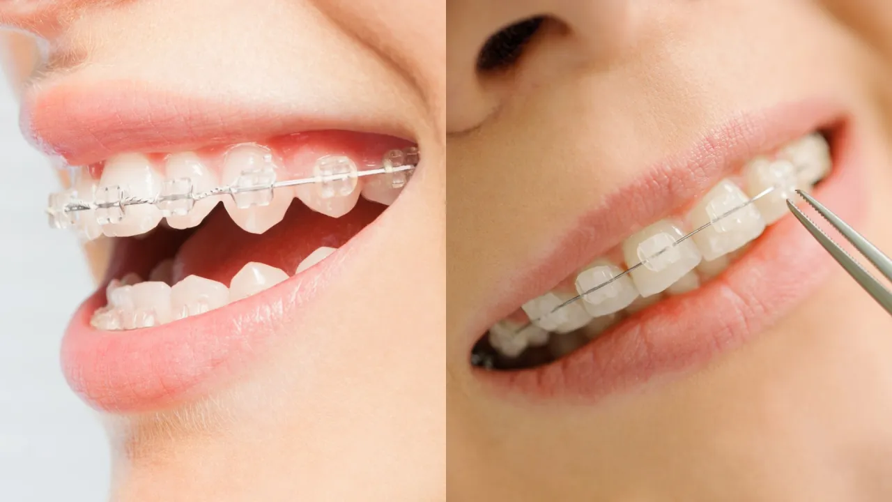 rodzaje aparatów ortodontycznych