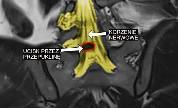 rezonans magnetyczny kręgosłupa ucisk na nerw