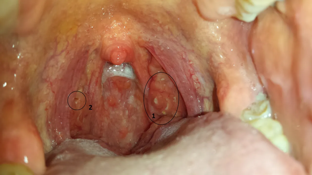 kamienie migdałkowe detryt