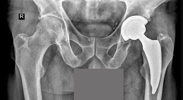 Zdjęcie Endoproteza stawu biodrowego nfz gdzie najlepiej – wybierz mądrze