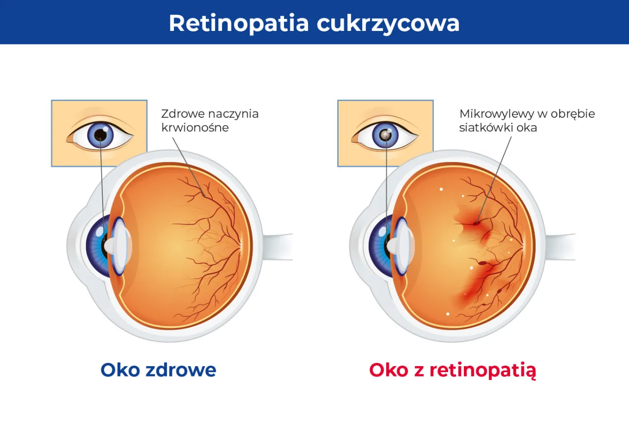 Oko siatkówka retinopatia