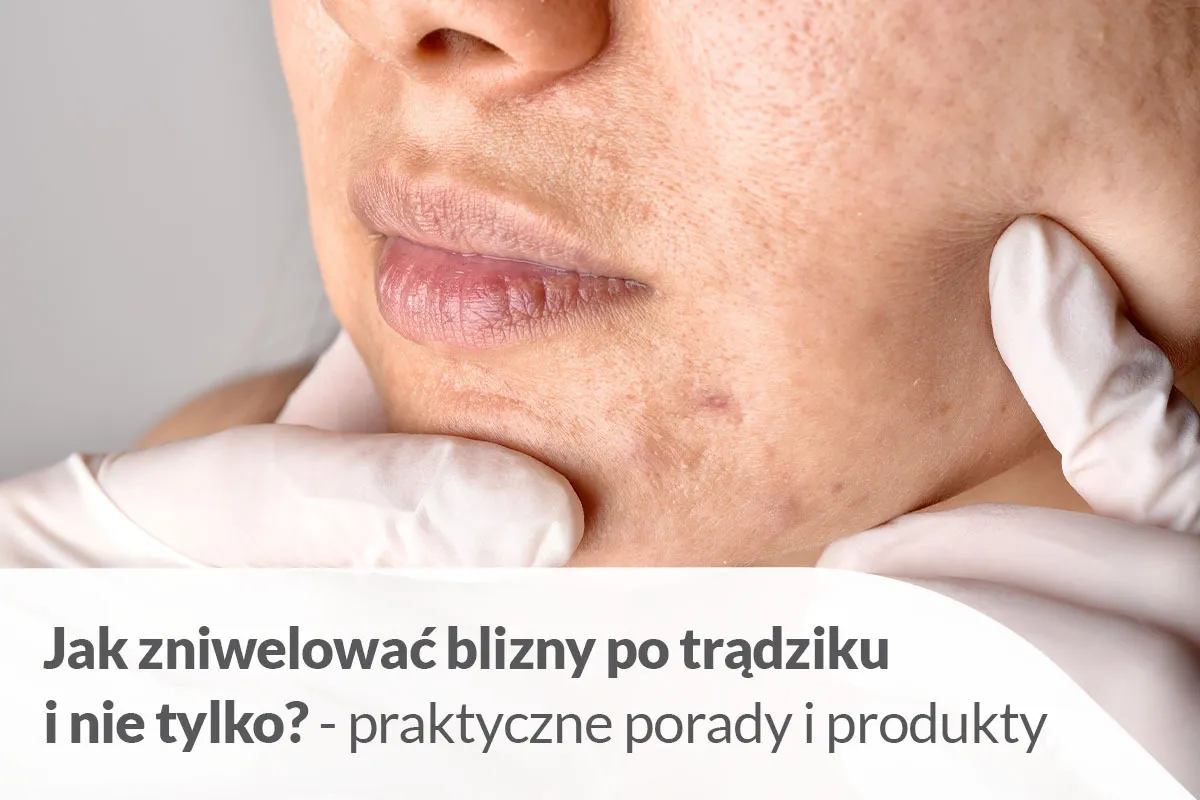 Czerwone plamy po pryszczach na twarzy. Dowiedz się, czym wybielić czerwone plamy po pryszczach i jak pozbyć się blizn.