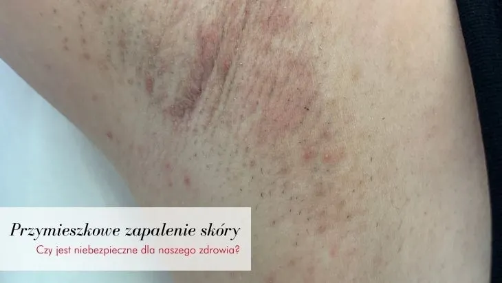 skóra po depilacji laserowej zaczerwienienie obrzęk