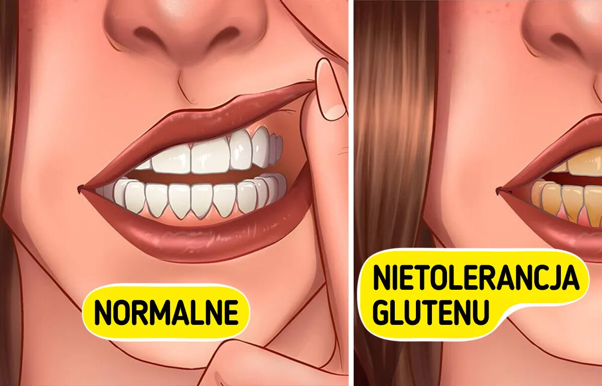 objawy sk&oacute;rne nietolerancji glutenu, zmęczenie mgła m&oacute;zgowa