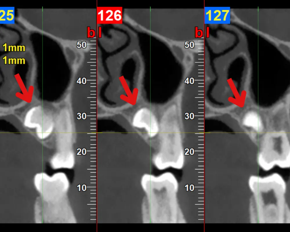 zdjęcie pantomograficzne brak zawiązk&oacute;w zęb&oacute;w