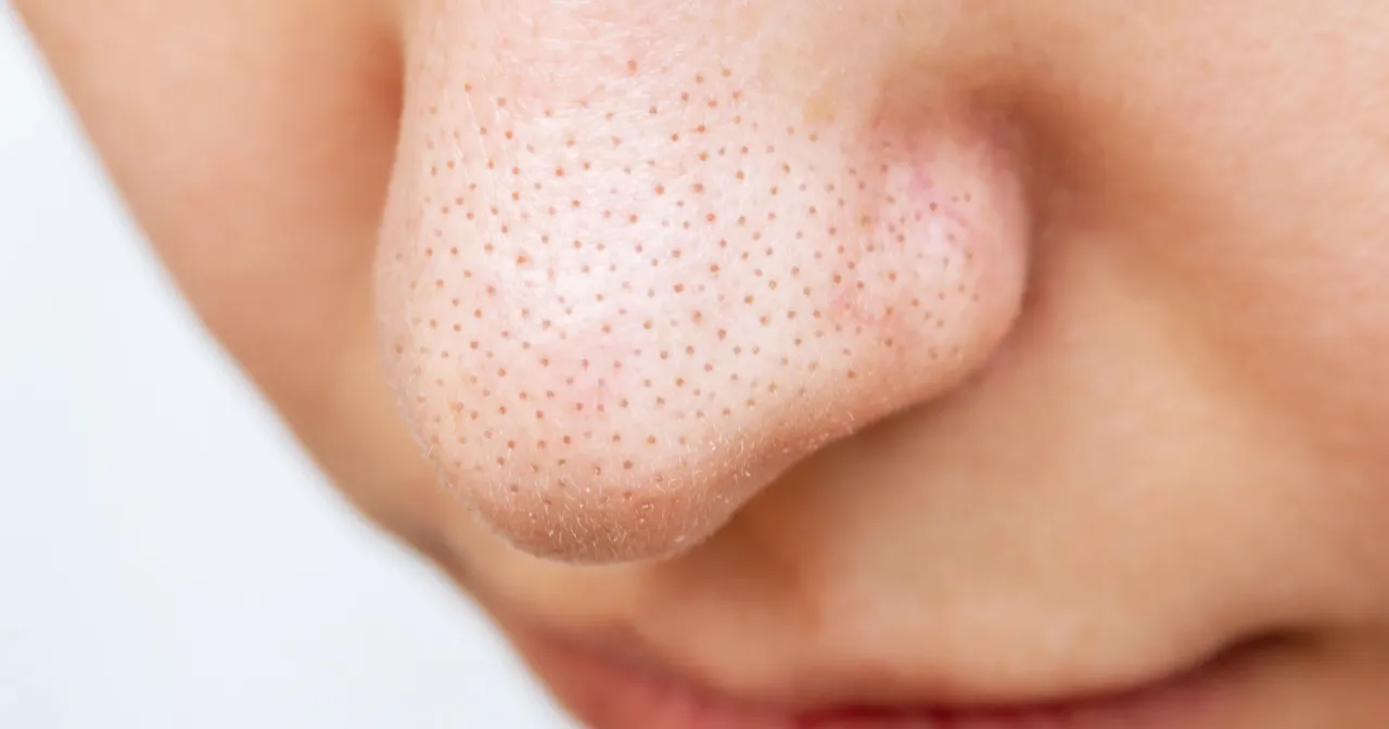 Kwasy do twarzy trądzikowej rodzaje