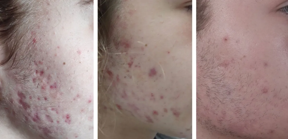 przebarwienia po pryszczach vs blizny różnice