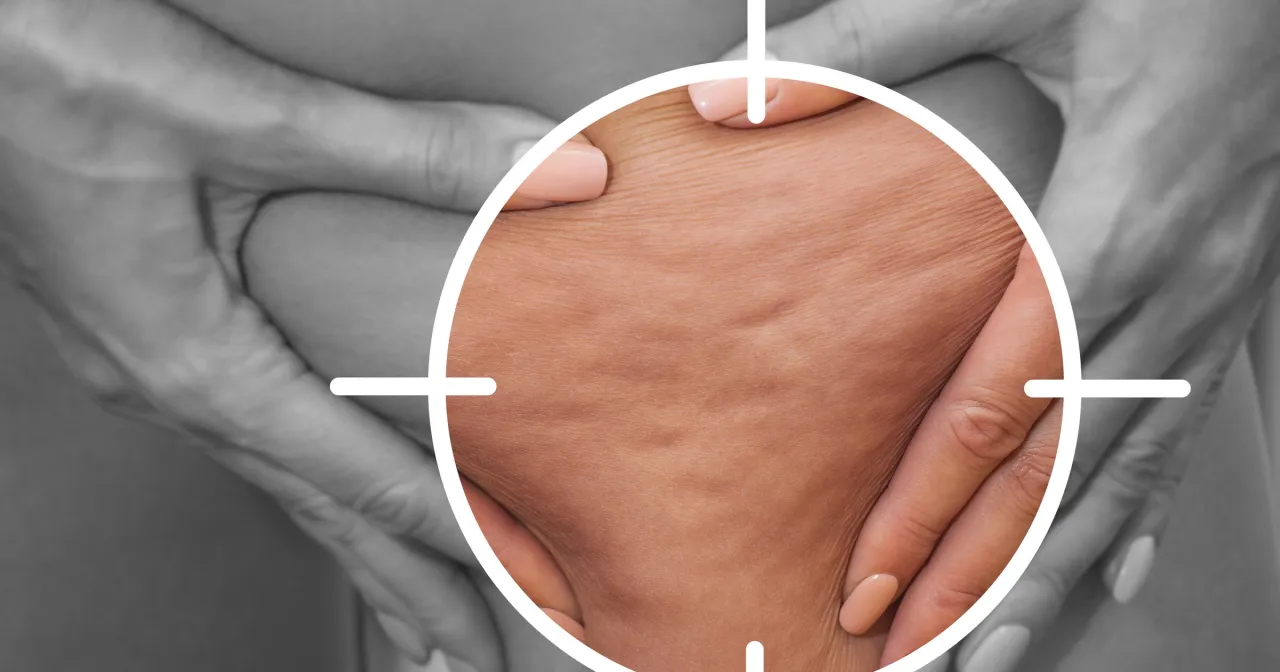 rodzaje cellulitu wodny tłuszczowy porównanie