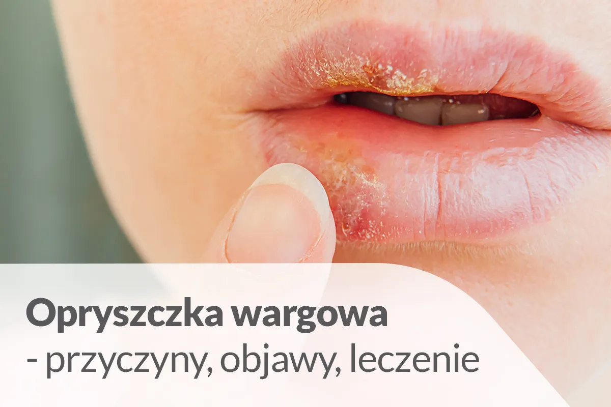 etapy gojenia opryszczki wargowej