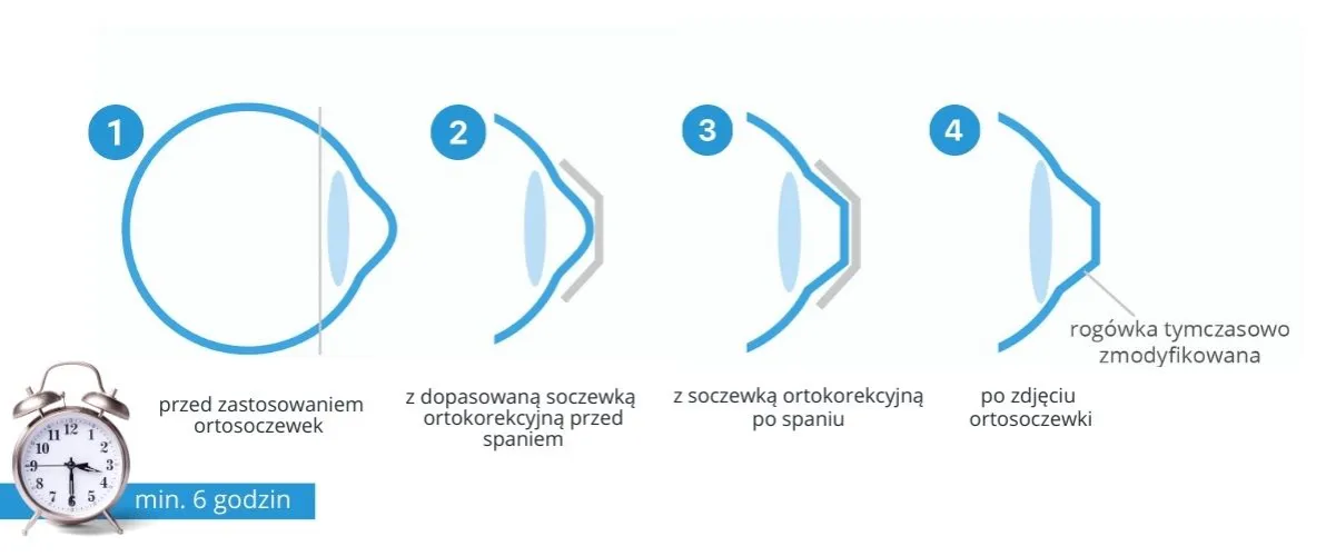 soczewki ortokorekcyjne na oku