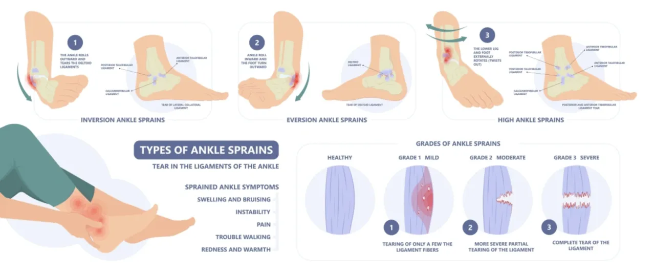 Stopnie skręcenia stawu skokowego grafika
