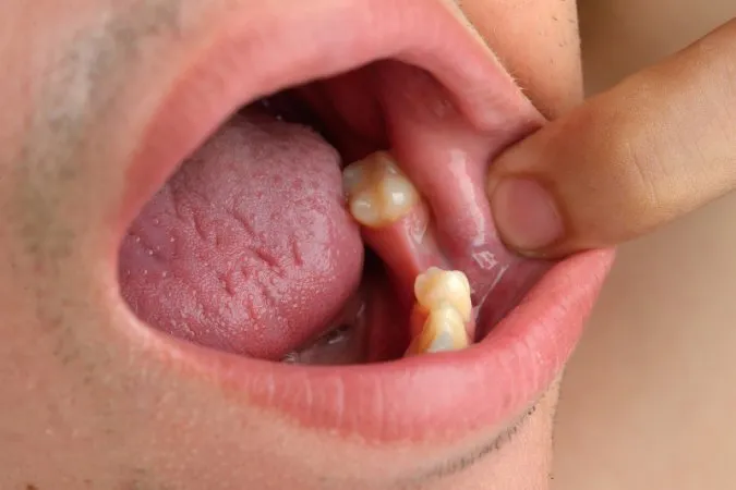 objawy suchego zębodołu infografika