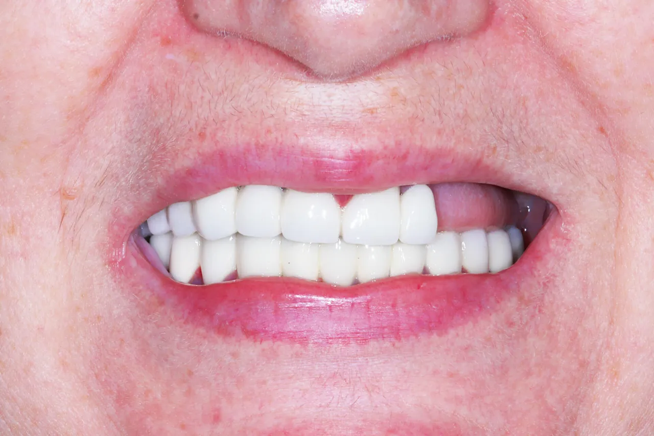 przykłady zębów do ekstrakcji ortodontycznej lub zniszczonych