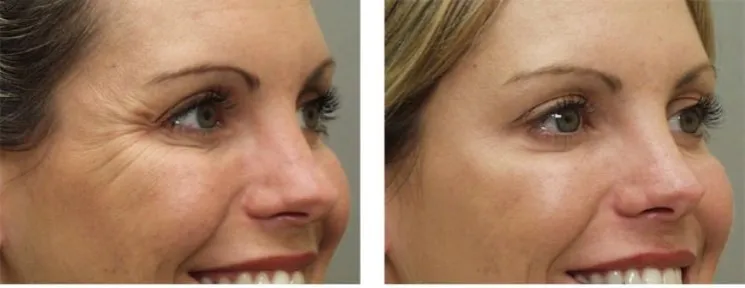 botoks czoło lwia zmarszczka kurze łapki przed i po