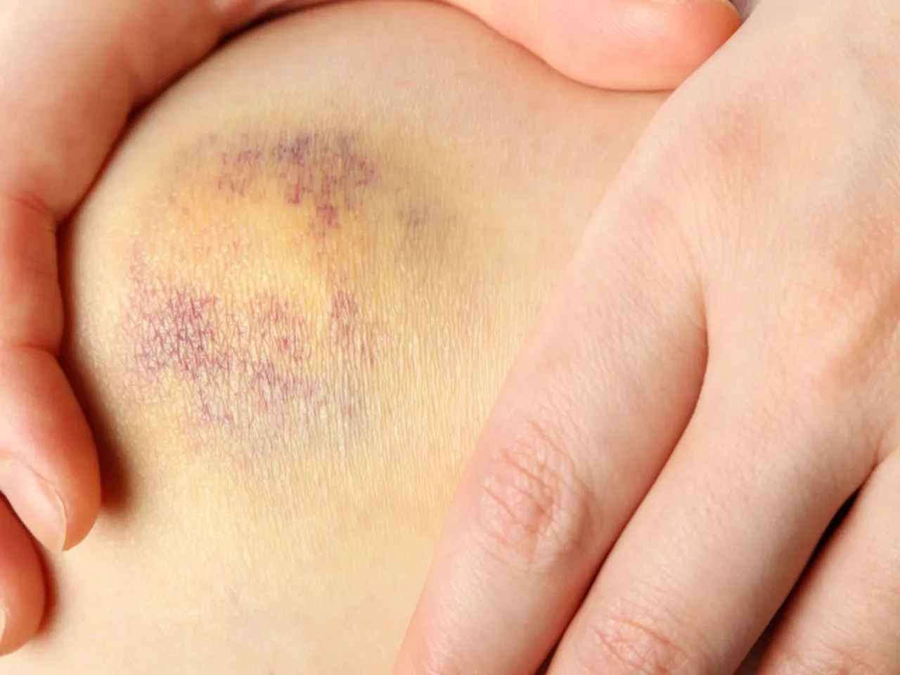 domowe sposoby na siniaki ocet kapusta