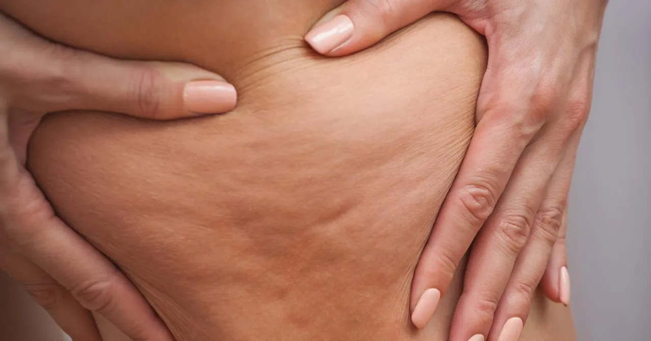 Dłonie delikatnie ściskają skórę z widocznym cellulitem, symbolizując drogę, jak pozbyłam sie cellulitu.