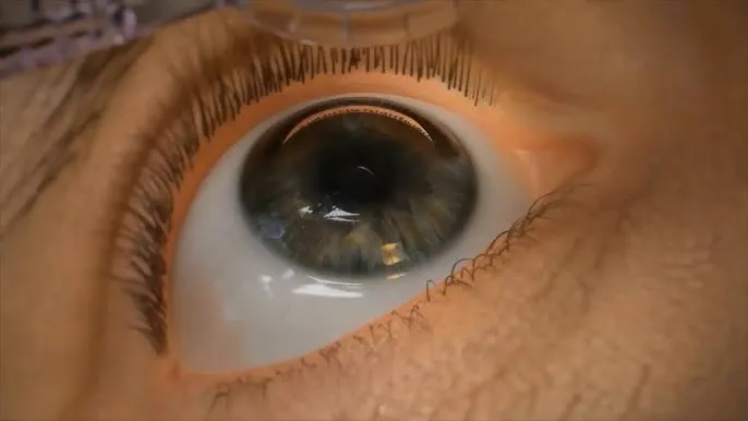 Laserowa korekcja wzroku animacja