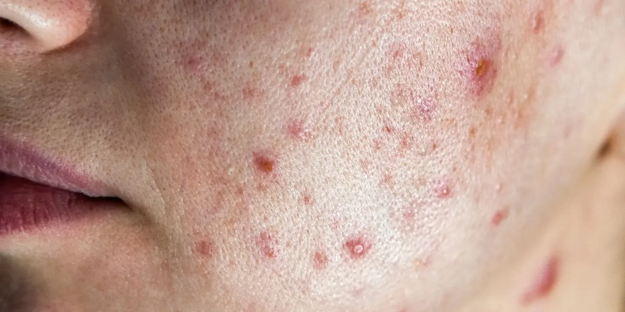 dermatolog konsultacja trądzik, poważne zmiany skórne