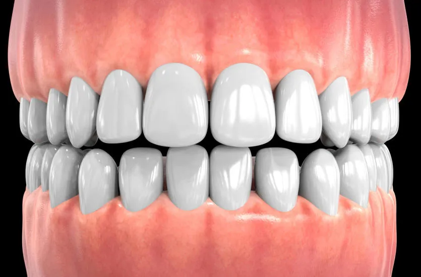 zdrowe dziąsła vs chore dziąsła porównanie