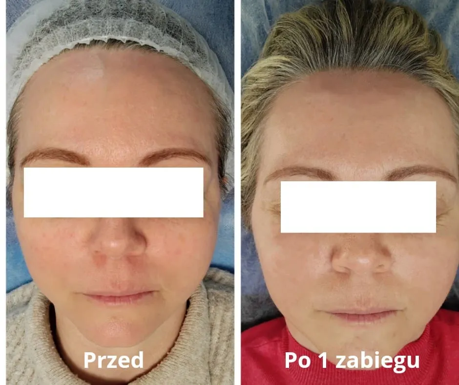 radiofrekwencja mikroigłowa przed i po