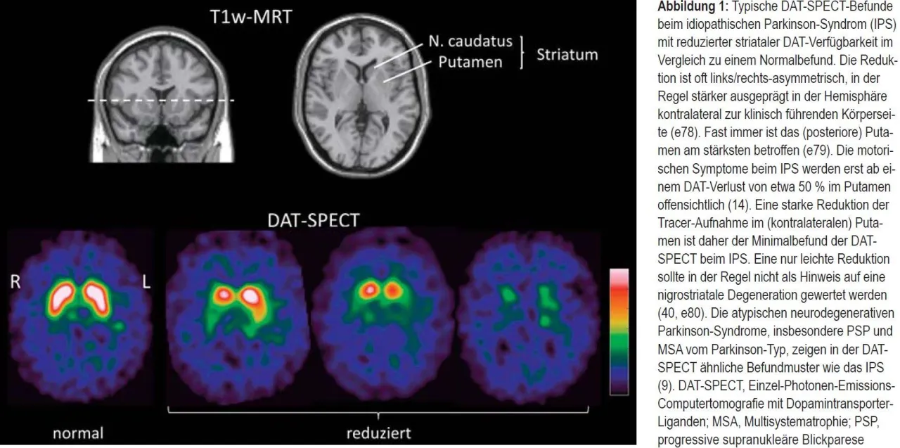 DaT-Scan Gehirn Parkinson