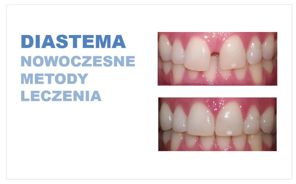 Metody leczenia diastemy: bonding, licówki, aparat ortodontyczny przed i po