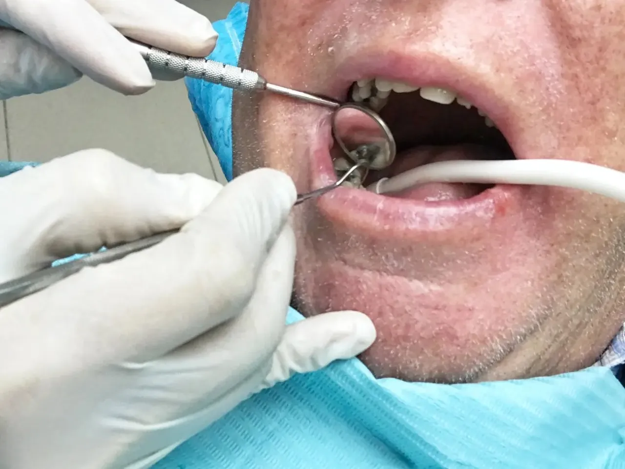 dentysta usuwanie zęba z ropniem