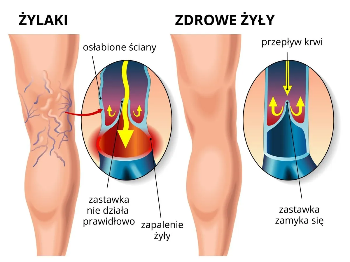 objawy żylaków nóg pajączki obrzęki