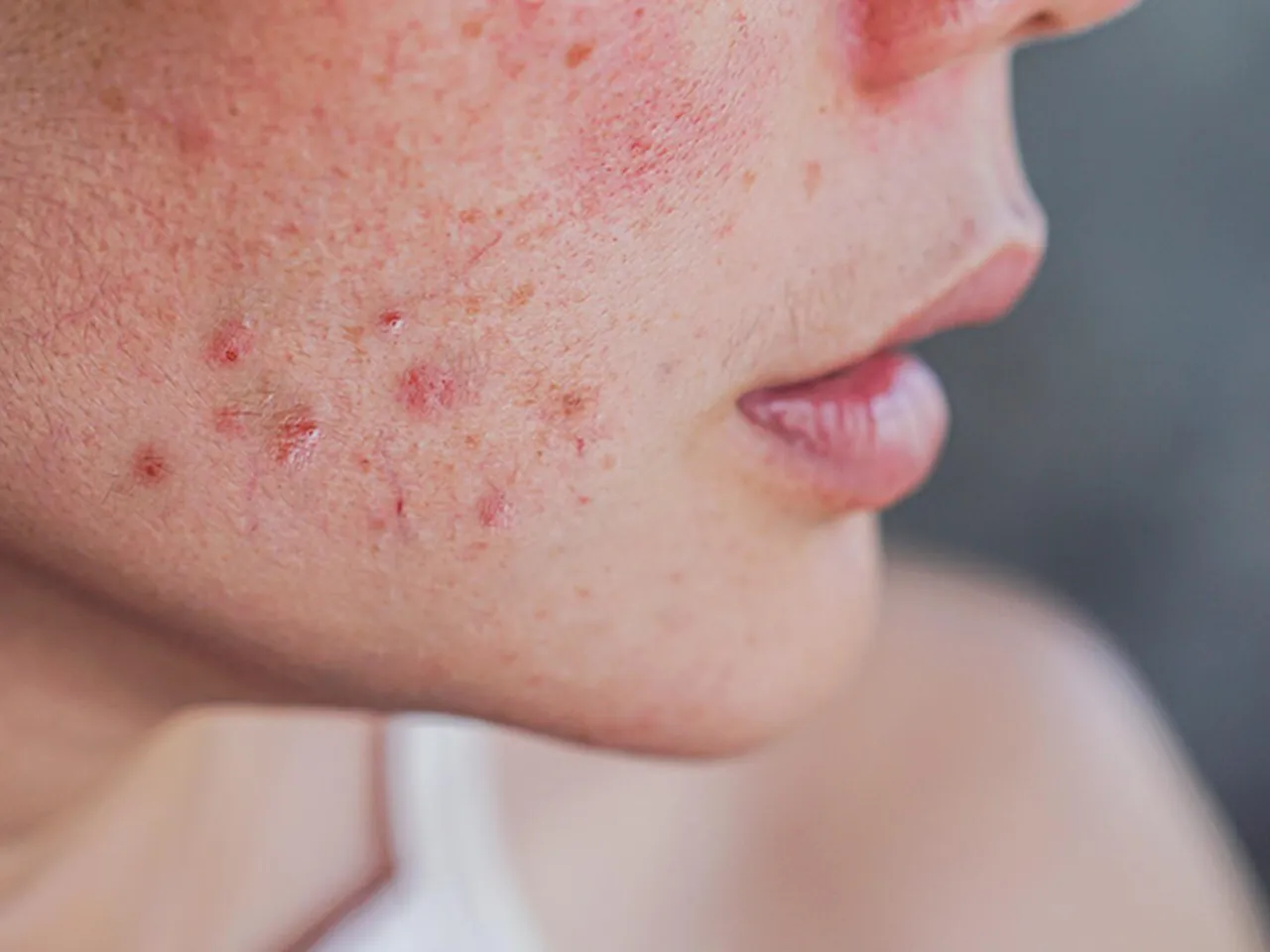 kontaktallergie gesicht