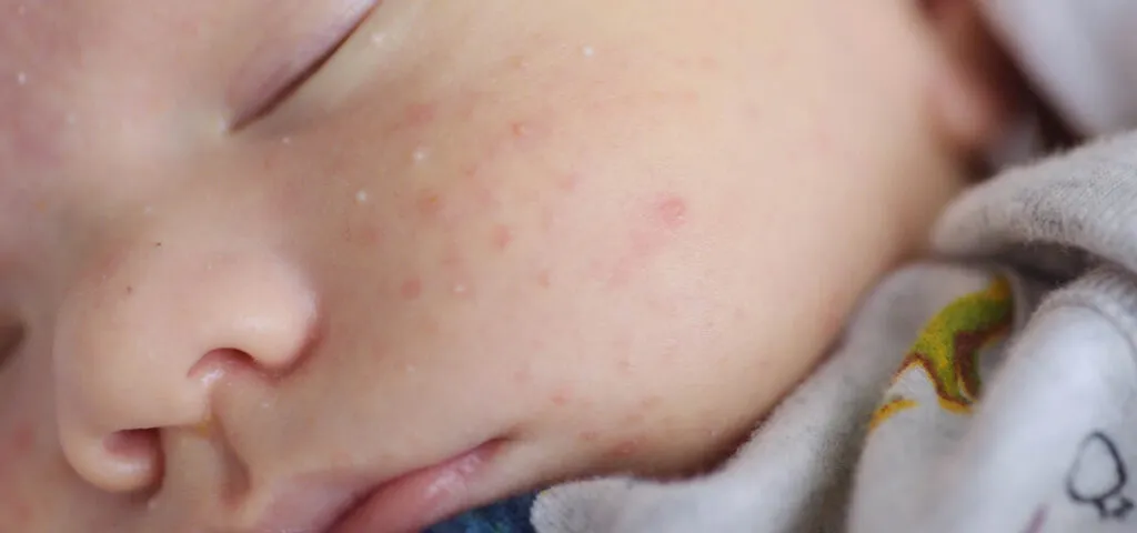 rodzaje potówek u niemowlaka zdjęcia