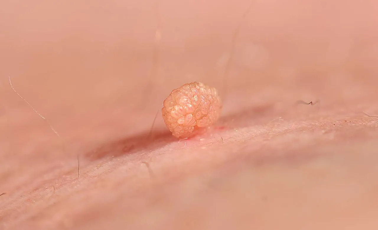 lokalizacja kłykcin kończystych u kobiet i mężczyzn