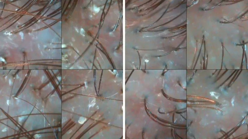 skóra przed i po delikatnym peelingu enzymatycznym