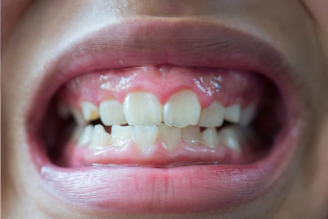 Widoczne białe zęby i różowe dziąsła. Na jednym z zębów widoczna jest niewielka nadżerka na dziąśle, która wymaga uwagi.