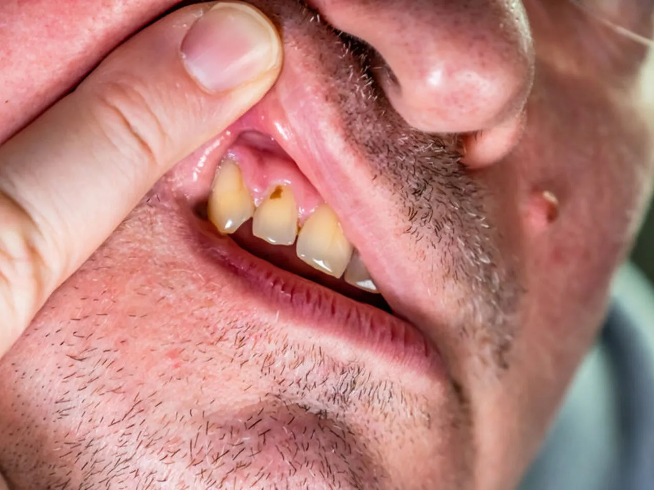 ropa w dziąśle objawy