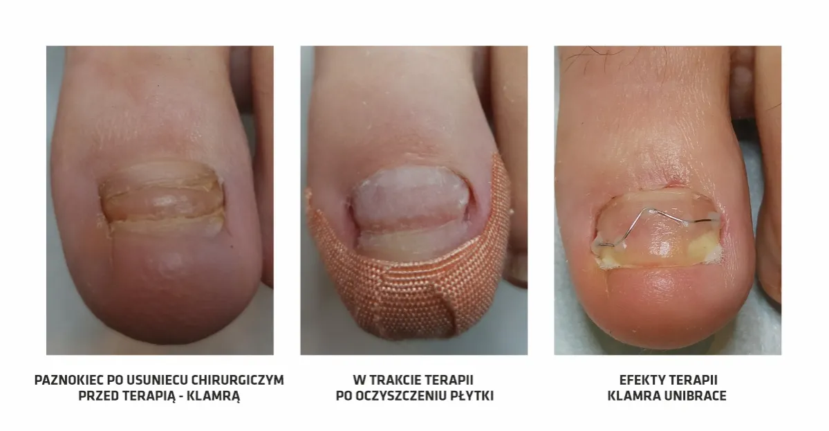 Zdjęcie Jak pozbyć się wrastającego paznokcia: skuteczne metody i porady