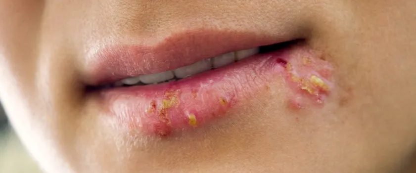 Zdjęcie Czy z zimnem można iść do dentysty? Sprawdź, co musisz wiedzieć