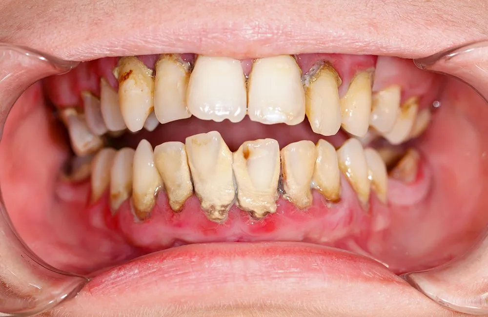 Zdjęcie Skuteczne metody na krwawiące dziąsła - poznaj przyczyny i leczenie