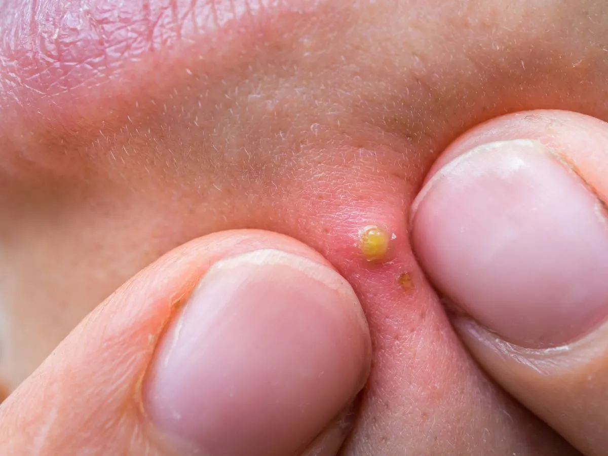 rodzaje pryszczy do wyciskania i nie do wyciskania