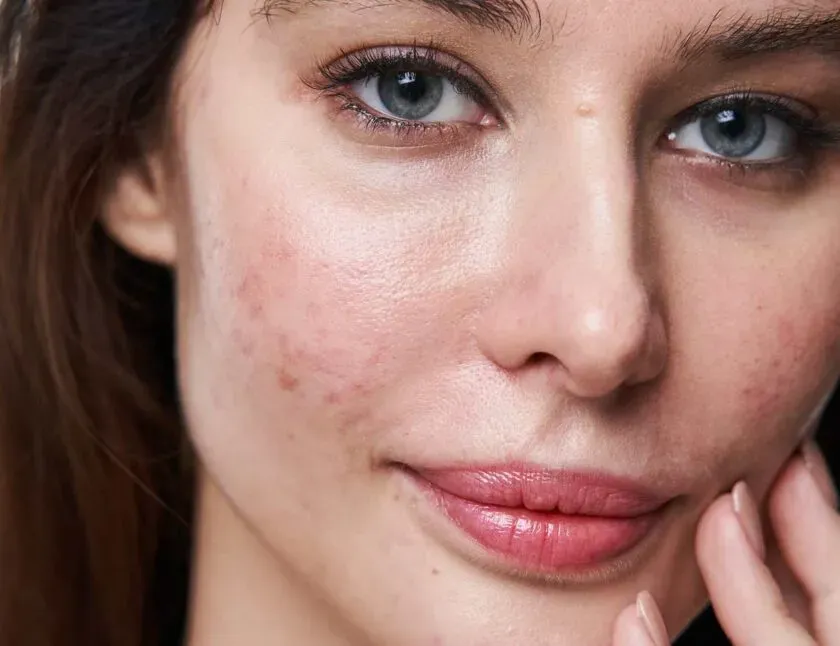 zabiegi na przebarwienia po trądziku gabinet