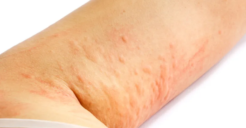 Wyprysk kontaktowy zdjęcia reakcji na metale kosmetyki detergenty