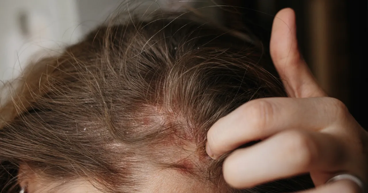Skóra głowy z zaczerwienieniami i łuskami, objawy łojotokowego zapalenia skóry. Dłoń delikatnie dotyka włosów.