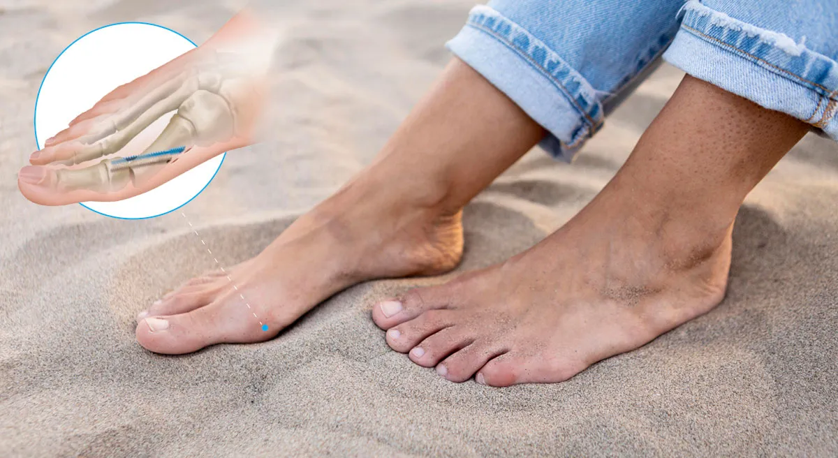 Operacja haluksa metoda MICA, stopa po operacji małoinwazyjnej