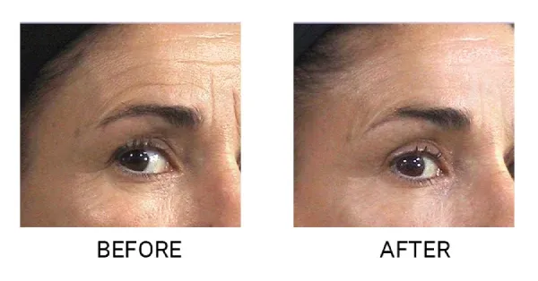 wskazania do endermologii twarzy przed i po