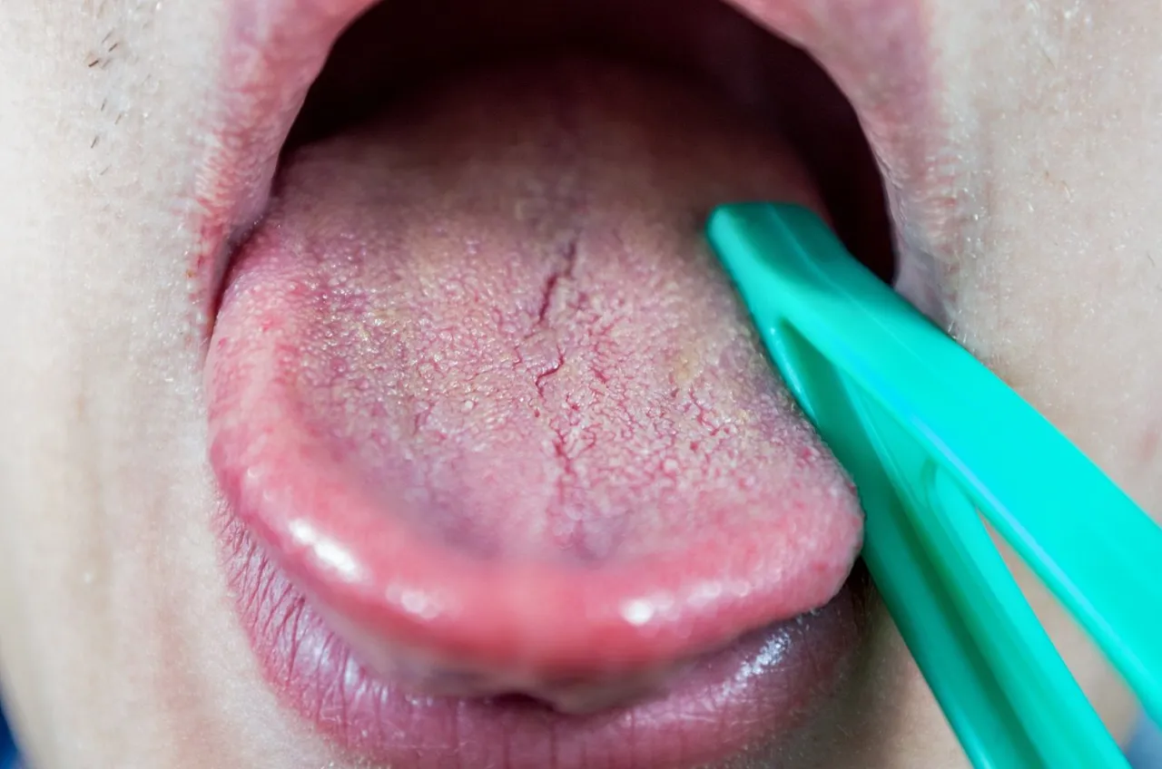 język bawoli niedoboru kwasu foliowego