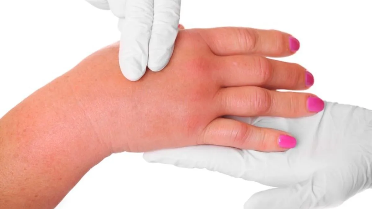 Opuchnięte dłonie w ciąży, obrączka na palcu