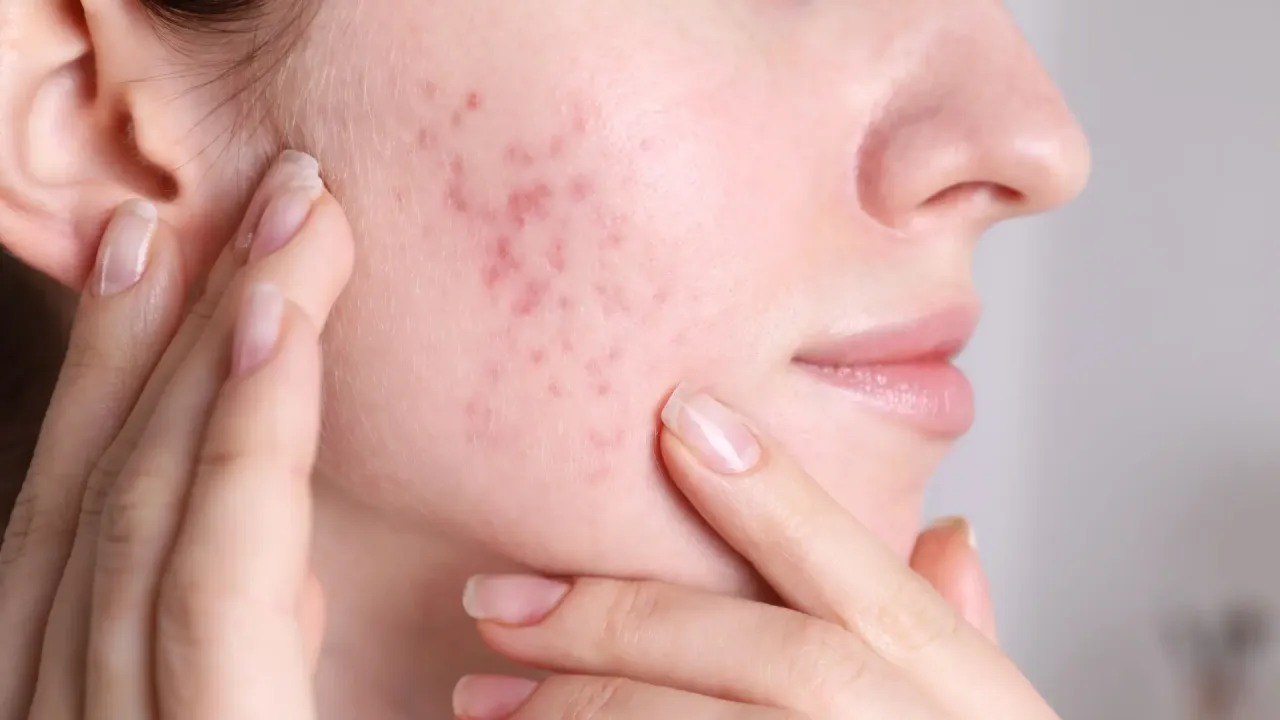 Pielęgnacja cery problematycznej